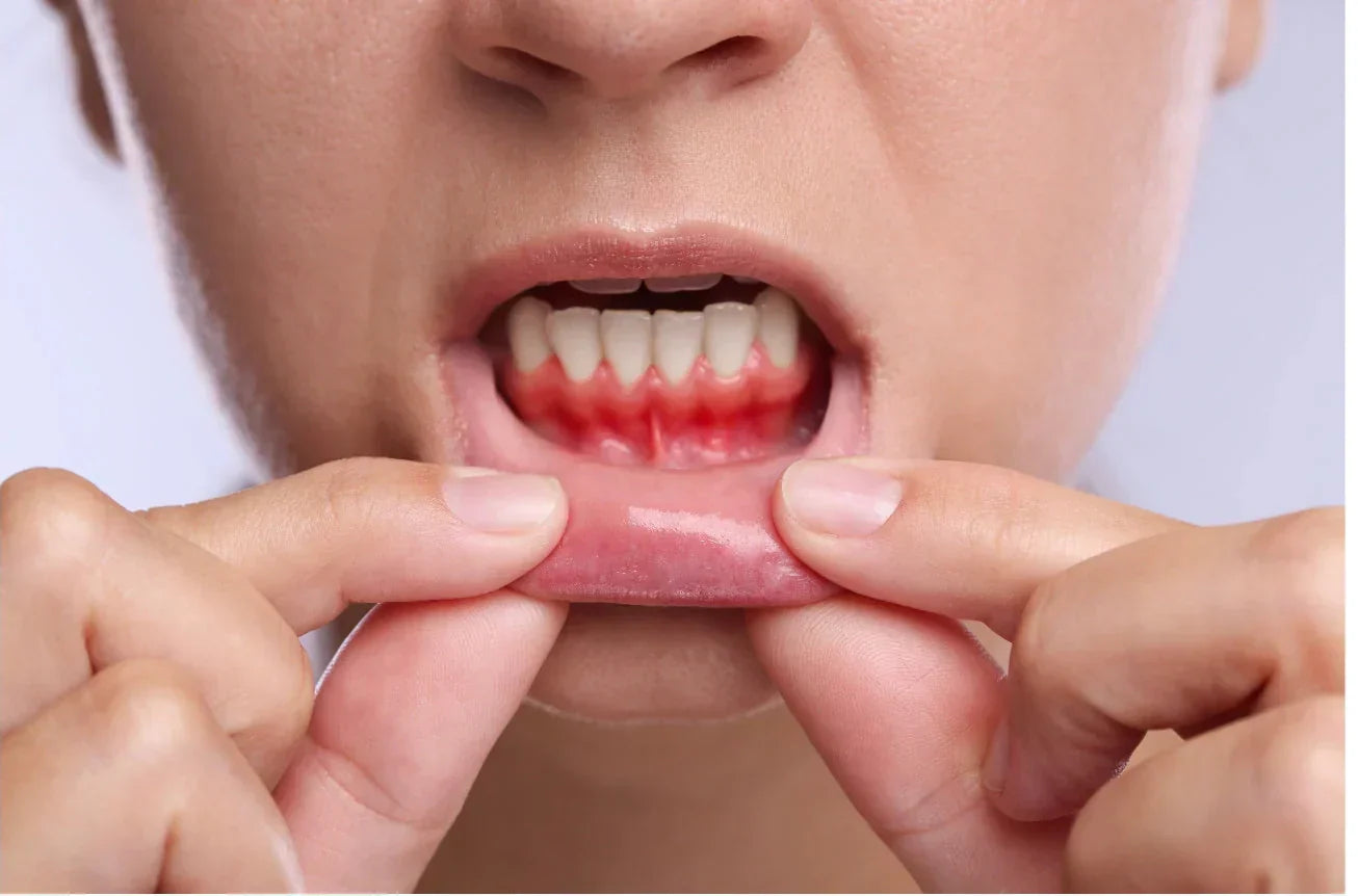 Treating Gum Inflammation: What Actually Works — and the Most Common Causes of Periodontitis in the USA