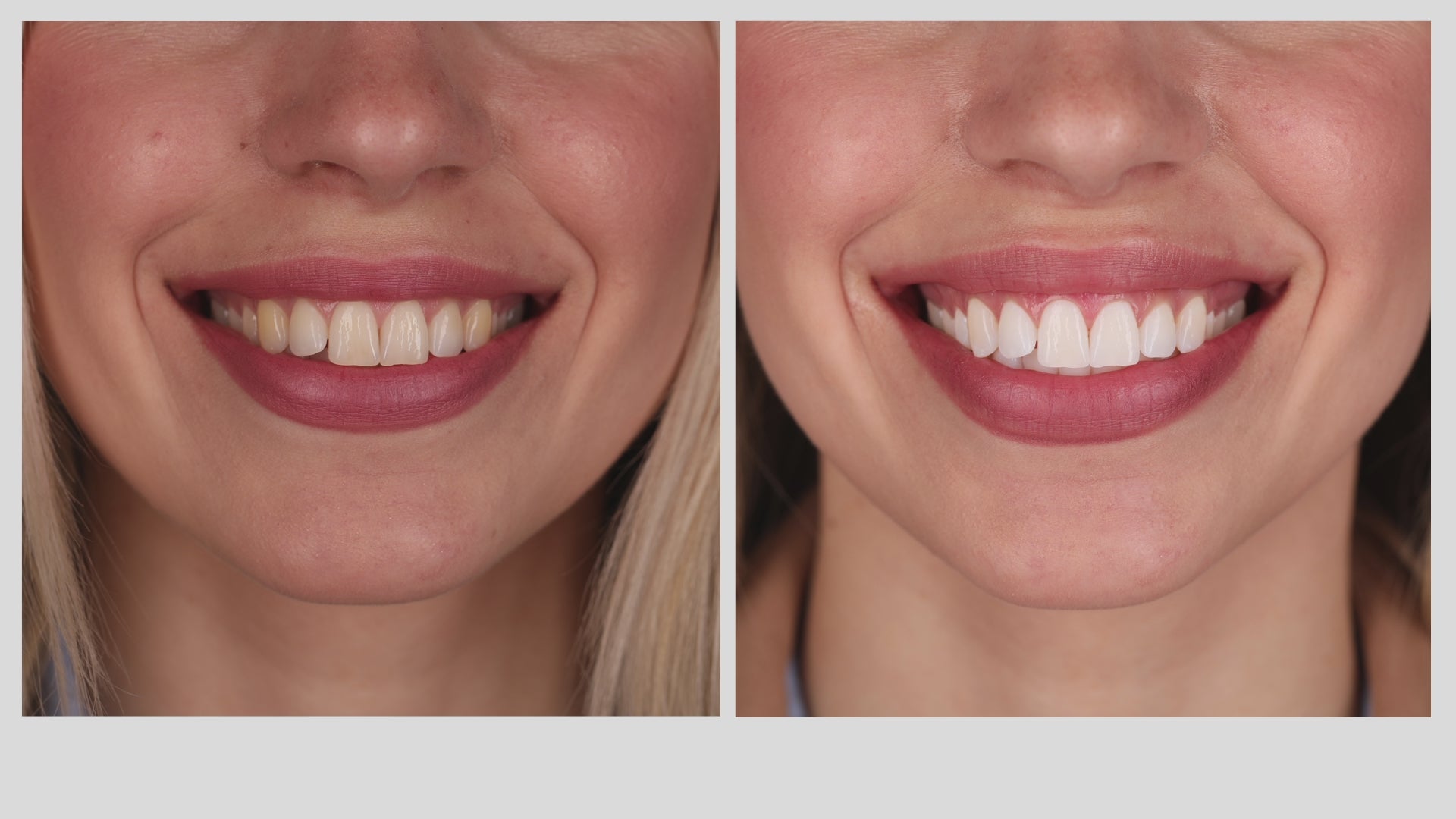 MINT Hollywood Smile Whitening Strips – 7-Day Treatment